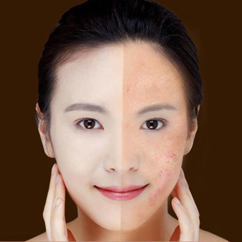 Before and after comparison of a woman's face with visible skin issues on a brown background