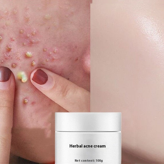 Acne-prone skin with a finger pointing to spots, next to a jar of herbal acne cream.